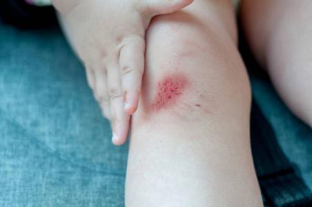 膝盖出血有几种原因